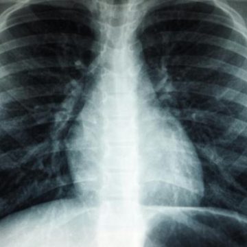 Un nouveau programme de dépistage du cancer du poumon