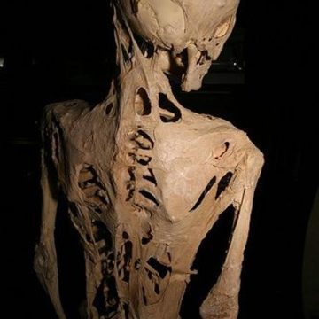 La Fibrodysplasie Ossifiante Progressive : Une Affection Rare aux Conséquences Dramatiques