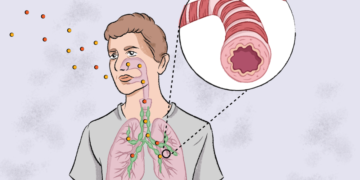 Asthme : Défis et Innovations dans le Traitement de cette Maladie Respiratoire