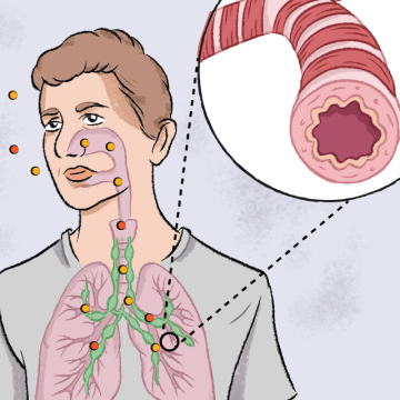 Asthme : Défis et Innovations dans le Traitement de cette Maladie Respiratoire