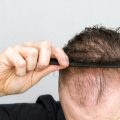 Un remède traditionnel pourrait freiner la calvitie