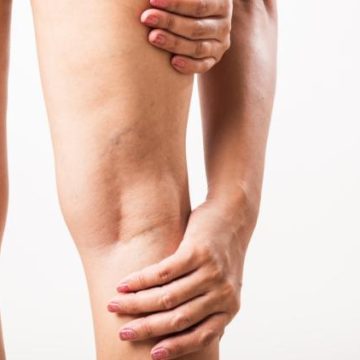 Les symptômes des varices à surveiller