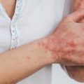 Une avancée génétique contre le psoriasis résistant