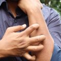 Comment soulager efficacement les piqûres d&rsquo;insectes