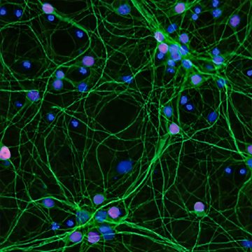 Les avancées prometteuses du traitement de la maladie de Charcot