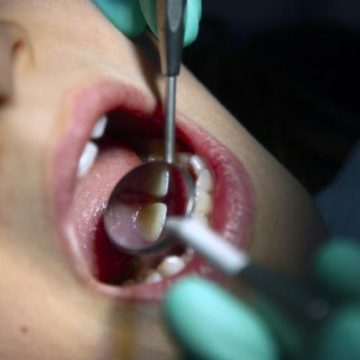 Baisse de la prise en charge des soins dentaires par l&rsquo;Assurance maladie